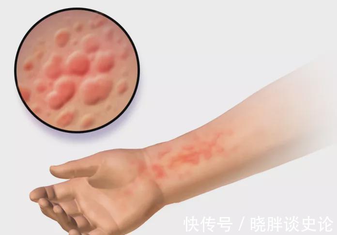 抗组胺药|宝宝得荨麻疹总是想挠怎么办？这个治疗办法百试不爽！