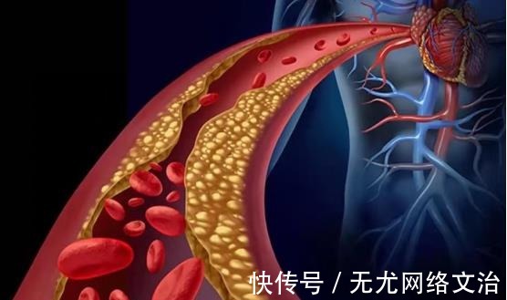 克星|高血脂“克星”公开,避免做这几件事,血管干净通畅