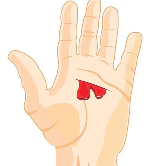 家长们|“白血病”专挑孩子下手,家长警惕:孩子有5个异常,请及时排查