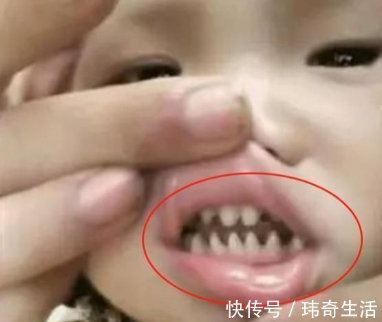 乳牙|宝宝长了一口“鲨鱼牙”,妈妈无奈送医求助,医生:怪家长无知