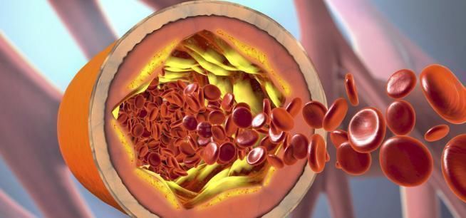 血管堵塞|溶栓“高手”找到了，不是大蒜，没事敞开喝，血管会感谢你