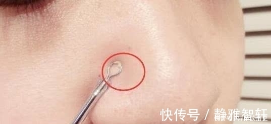 鼻子|女生鼻子上能挤出“毛毛虫”?教你3个小妙招,远离“草莓鼻”!