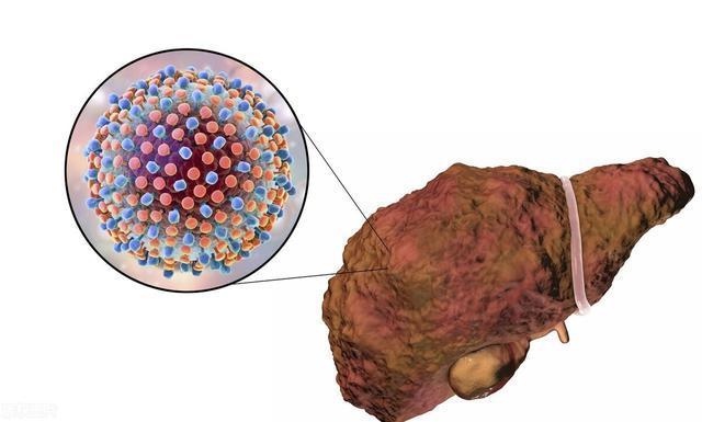 老晨|男子误以为是肩周炎，却查出肝癌，医生是妻子的无知害了他