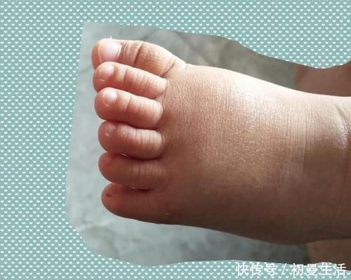 畸形|新生儿出生后有6个脚趾,医生在指尖“绣花”,网友:巧夺天工