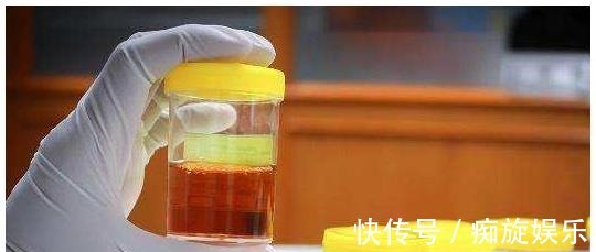 糖尿病|上厕所后，出现3种情况，说明血糖高了！糖尿病患者要留心