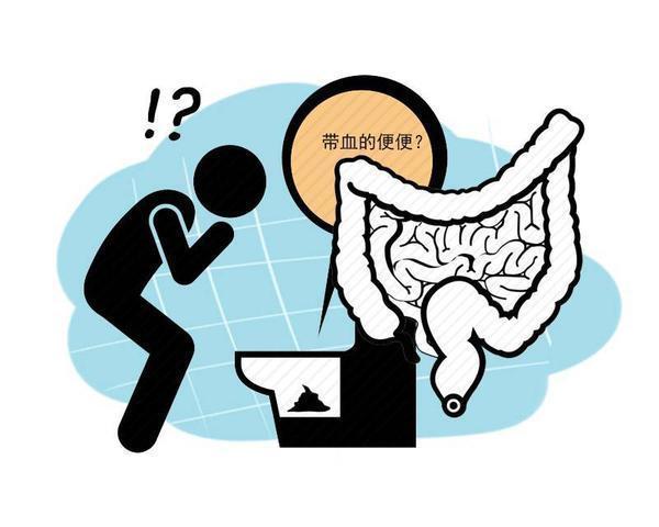 癌肿|排便有4个症状找上你时,当心是肠道已发生癌变,及时检查