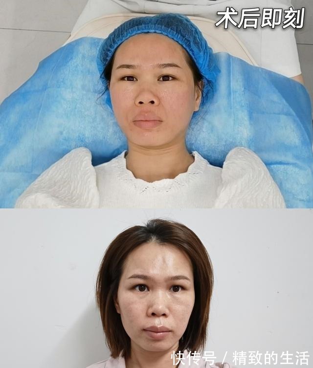 恢复 微针术后7天恢复情况是怎样的!