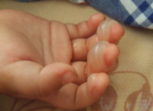 凉水|5岁孙子被开水烫伤,奶奶临危不乱及时处理,获医生称赞 !