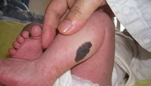 辐射|怀孕时,孕妈若想让宝宝远离胎记,在这4件事上可得长点心了