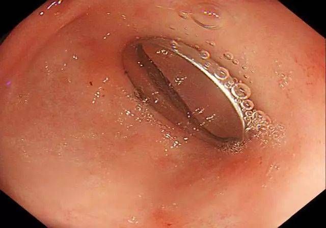 小婉|剖腹产有三种后遗症,生娃后难发觉,怀二胎时才显露,希望你没中