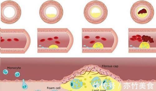 血管|甘油三酯的“头号强敌”发现,没事喝两口,血管畅通,血栓绕道走