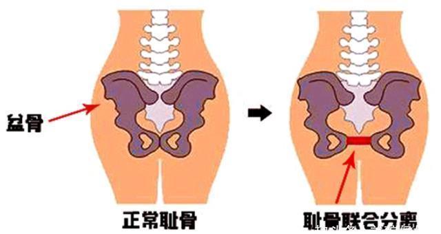 孕晚期耻骨疼怎么缓解 孕晚期耻骨疼怎么缓解