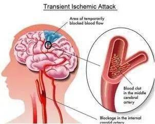 tiTIA来去匆匆不可忽视，它是脑梗死“前兆”