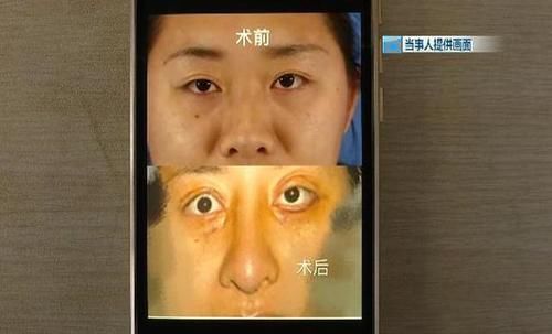 女子花60000整容,术后却整成“凹陷鼻”,找其理论主刀医生闭门不见