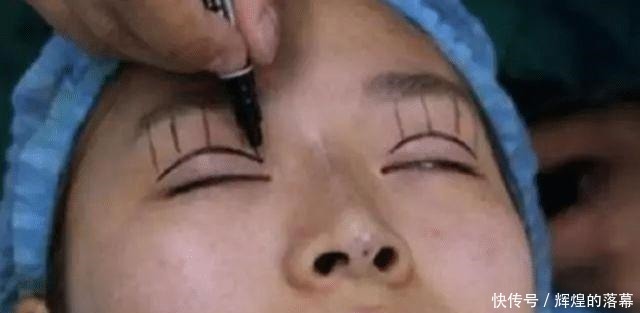 手术|做过双眼皮手术的年轻人,老了以后眼睛会怎么样看来是这个道理!
