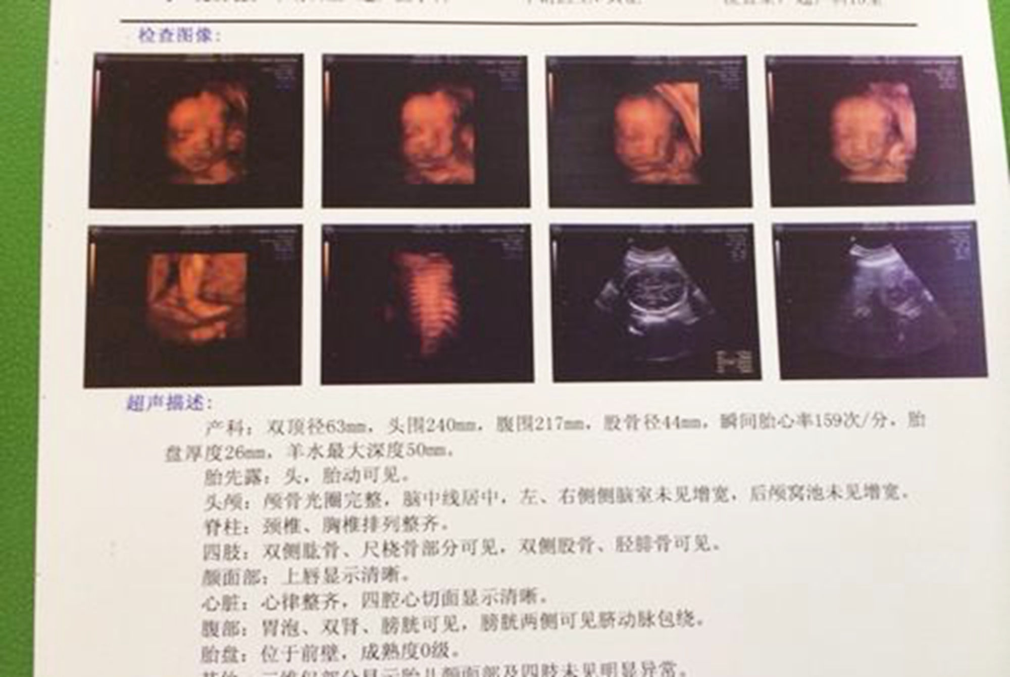 孕囊|孕早期B超单上的四个指标，暗含了胎儿的“小秘密”，你看得懂吗