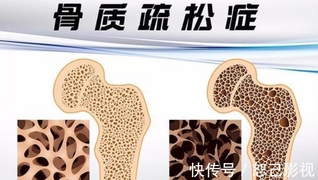 人体|吃虾皮可以补钙吗？医生：真正补钙的是这2物，很多人还不知道