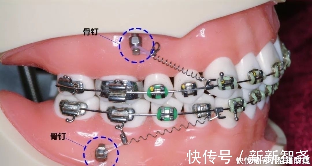 牙槽骨|牙齿矫正一般是什么时候打骨钉？矫正是不是必须打骨钉？