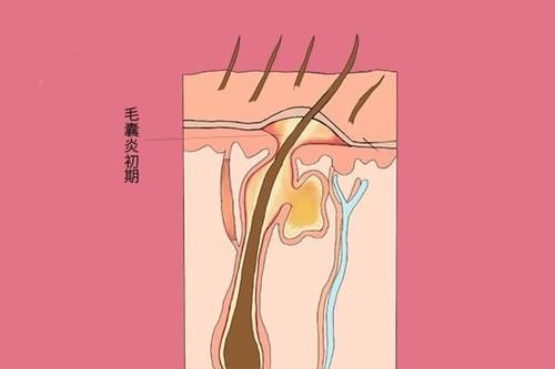 一挠头皮，指甲缝中全是白泥，是怎么回事？注意：未必是头皮屑