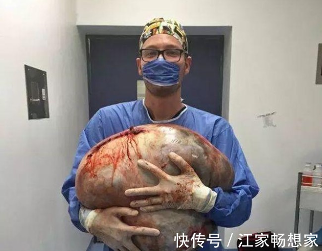 良性肿瘤|33公斤!史上最大的卵巢肿瘤!被医生整个从腹腔里取出了