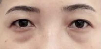 不用医美就可以解决？谁说眼袋不可逆～