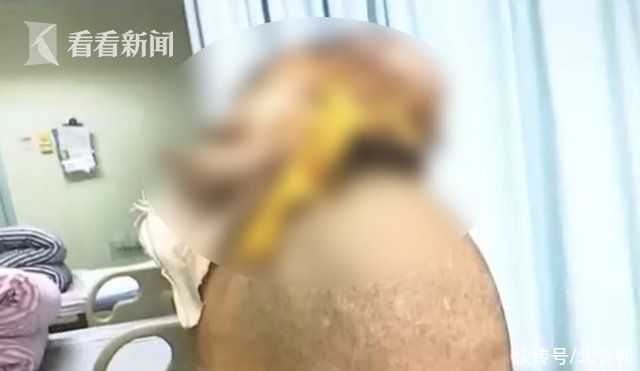 女子|偏信游医“土方法”女子头顶长出菠萝大肿瘤
