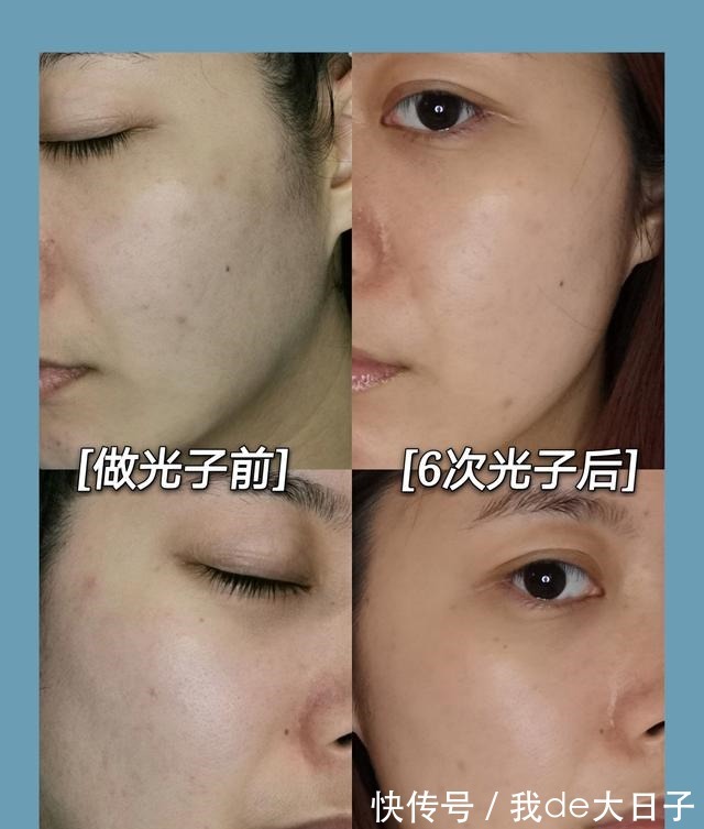 光子嫩肤 6次光子嫩肤后,我的脸怎么样了!