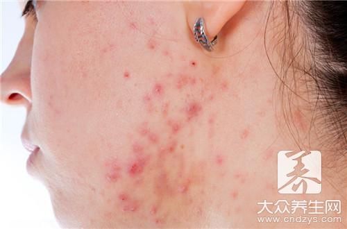 脖子上长了一颗痘痘 脖子后面经常长痘痘 快资讯