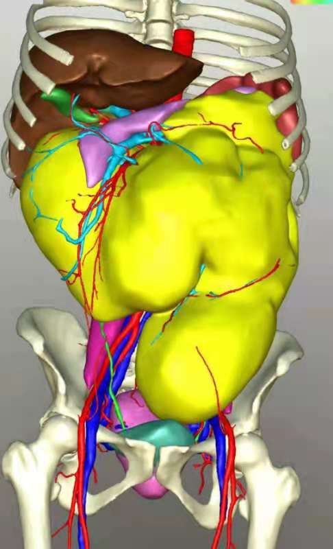 切除|腹腔肿瘤3年疯长30斤，西安交大一附属多学科联合成功切除