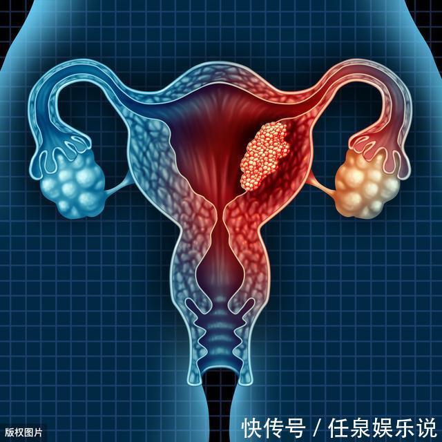 子宫|医生忠告女性“子宫”报废，身体3处会“发黑”，别撑到宫颈癌