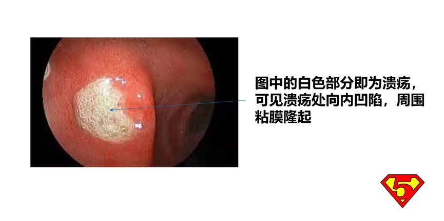 饮食习惯|糜烂性胃炎严重吗？医生：如不注意会引发胃溃疡，造成更严重后果