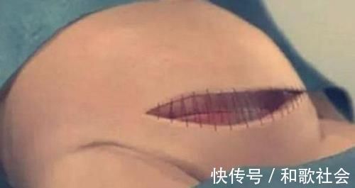 子宫|剖腹产只是“挨一刀”就完事?看完手术全过程,忍不住心疼女人