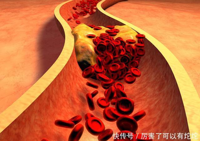 3位院士提醒:降血脂并不难,多吃1物,若坚持高血脂绕着走