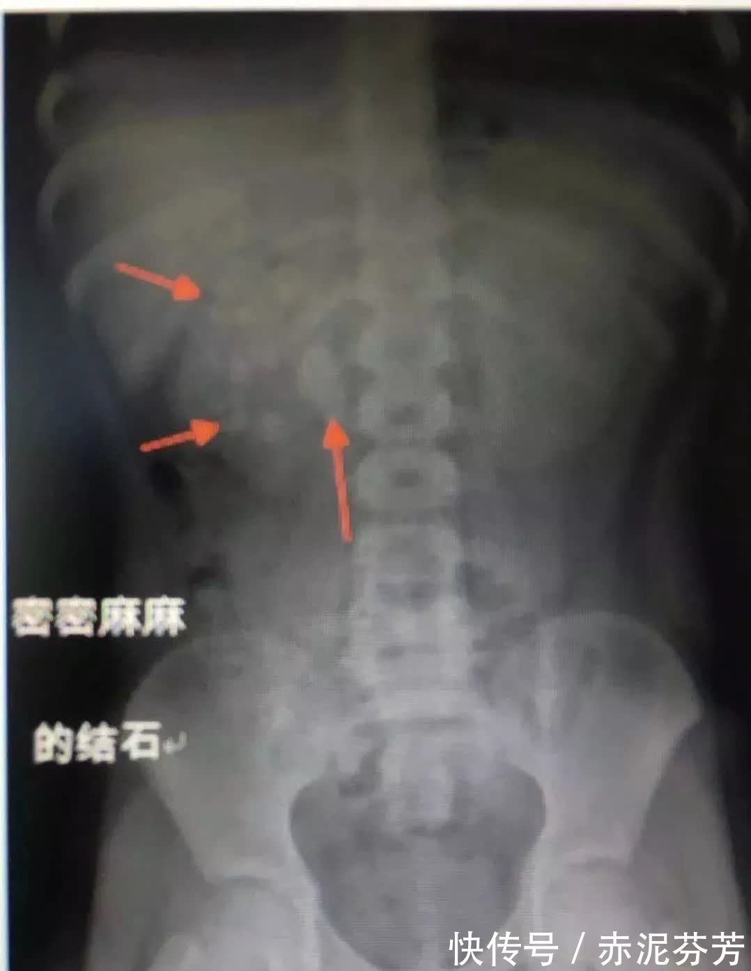 尿血|9岁男孩体内塞了56颗肾结石,只因天天吃这个,很多妈妈还在给孩子喂