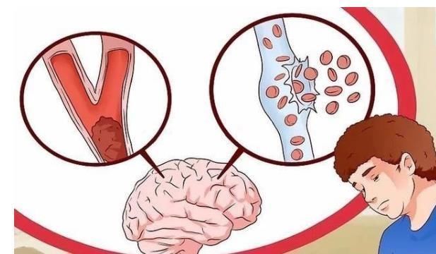 预防脑梗|预防脑梗，睡前经常做这一件事，能够帮你疏通血管，避免中风！