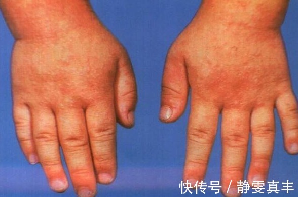 肉疙瘩|身上为什么会长出小肉疙瘩身体在向你表达什么呢