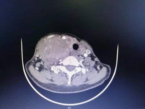 多学科|齐鲁医典｜最大直径10厘米！59岁女性巨大甲状腺髓样癌被切除
