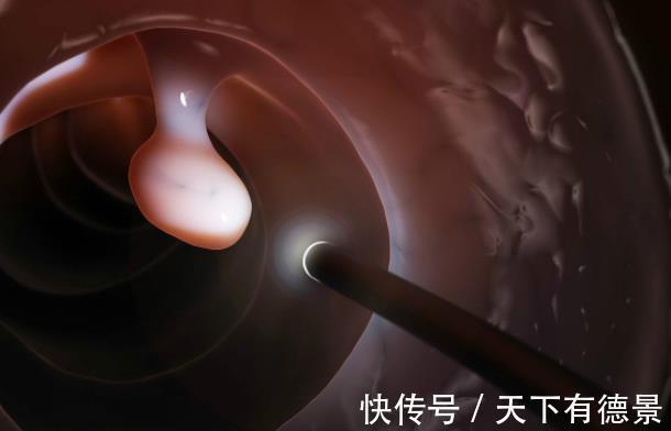 乳腺纤维瘤|三个良性肿块必须及时切除,延迟就会变成恶性肿瘤!你清楚吗?