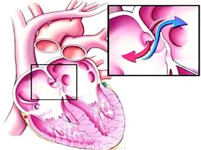 导管|知多点:长期不明原因头晕头疼?有可能是卵圆孔未闭