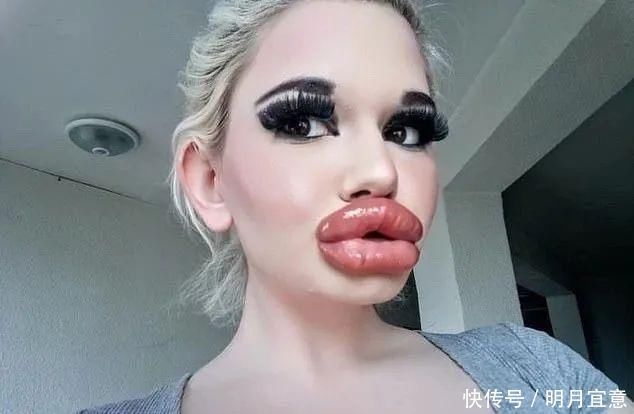 21次丰唇手术之后,这个妹子的嘴唇现在长这样…