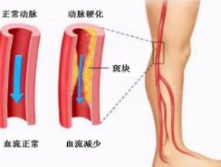 足背|腿脚凉走路还疼，可能是这“堵”了？