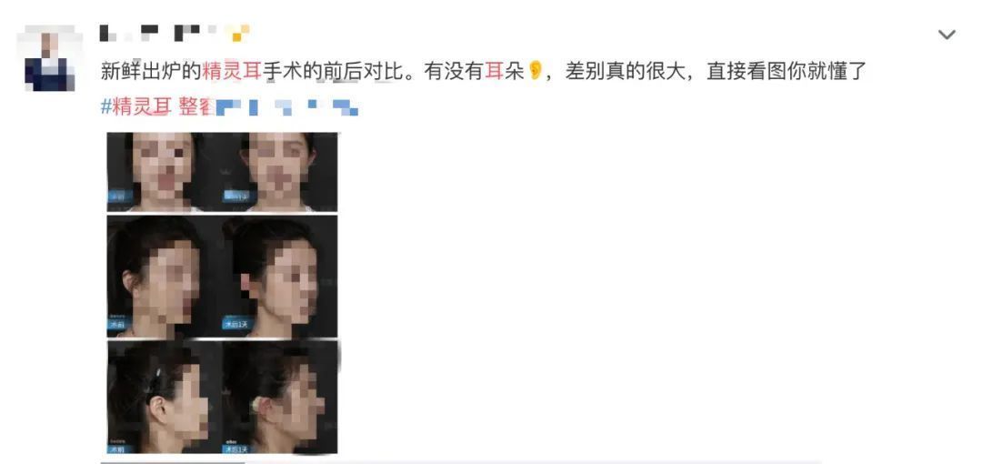 李钢|显脸小年轻?“精灵耳”整形受追捧,专家:可能显脸更大