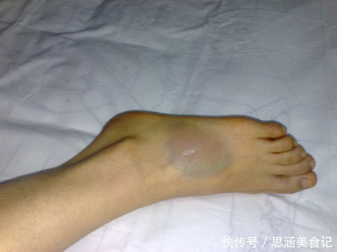 蕉叶|一个治脚崴伤的神奇中草药,当天用,第二天脚就能下地走路了