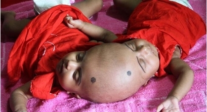 连体婴儿|印度妇女生下连体婴儿,无钱救治,送回老家,现如今让人羡慕