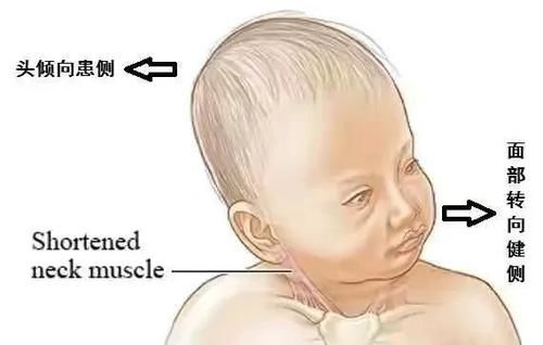 什么是宝宝斜颈，造成斜颈的原因是什么呢？