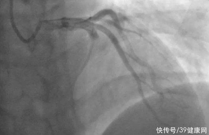 深静脉血栓|21岁突发心梗，医生掏出10块血栓！提醒：血栓喜欢“吃”3种食物