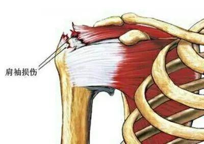 炎症|肩膀疼痛、肩周炎,甩甩肩,练练就好了错,大错特错
