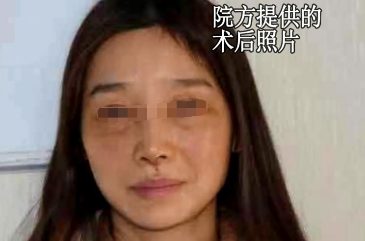 刘女士 花5万多做耳软骨隆鼻，女子术后竟不敢抬头！院方送你个双眼皮