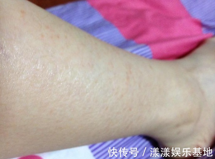 末端|糖尿病人小腿部出现几种现象,情况很危险,越拖越难治