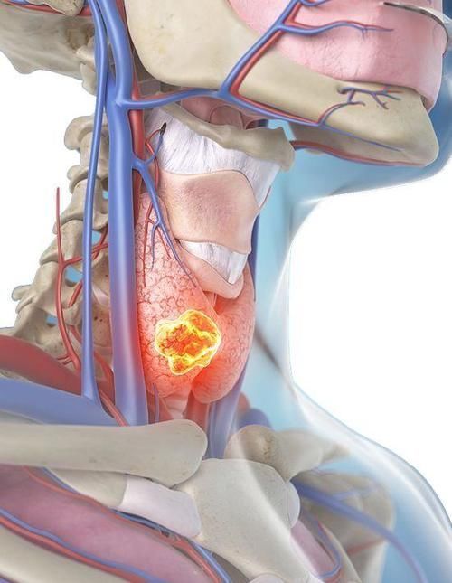 乳腺结节|体检出来的结节、囊肿、增生,到底会不会癌变?答案来了